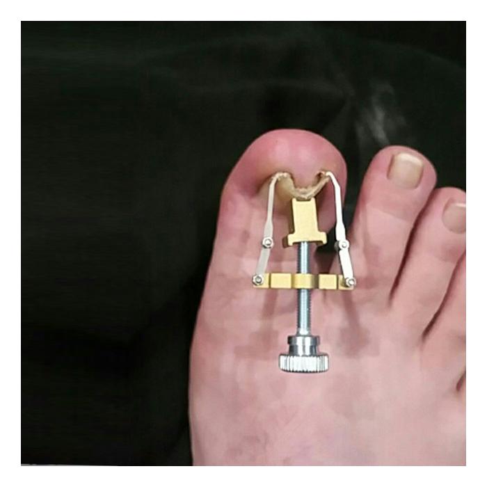 Batık Tırnak Düzeltme Aleti